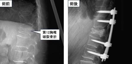 脊椎脊髄治療術前術後.jpg